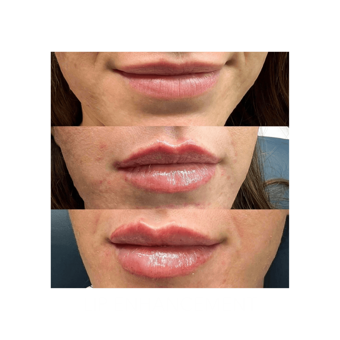 lips after and before treatment